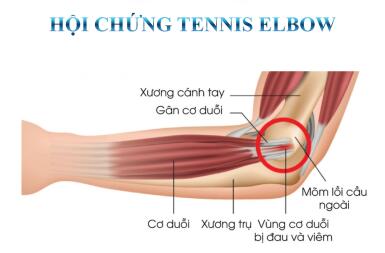 TENNIS ELBOW – VIÊM LỒI CẦU NGOÀI: ĐỪNG ĐỂ CƠN ĐAU ÂM Ỉ LÀM GIÁN ĐOẠN CUỘC SỐNG CỦA BẠN