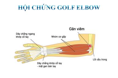 GOLF ELBOW – VIÊM LỒI CẦU TRONG: CƠN ĐAU ÂM Ỉ KHÔNG CHỈ CỦA NGƯỜI CHƠI GOLF