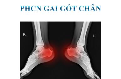 GAI GÓT CHÂN: ĐỪNG ĐỂ MỖI BƯỚC ĐI TRỞ THÀNH CỰC HÌNH – HÃY ĐIỀU TRỊ DỨT ĐIỂM CHỈ SAU 5-7 BUỔI TẠI VIỆN PHYSIO