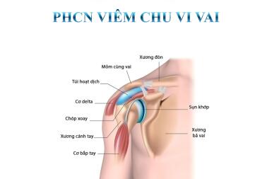 VIÊM CHU VI VAI – ĐỪNG ĐỂ CƠ VẬN ĐỘNG VAI BỊ “ĐÓNG BĂNG”