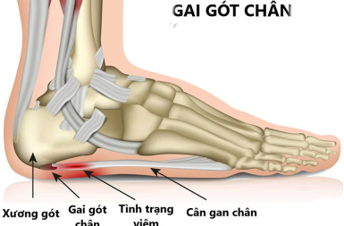 GAI GÓT CHÂN: ĐỪNG ĐỂ MỖI BƯỚC ĐI TRỞ THÀNH CỰC HÌNH – HÃY ĐIỀU TRỊ DỨT ĐIỂM CHỈ SAU 5-7 BUỔI TẠI VIỆN PHYSIO