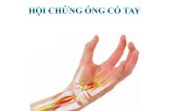 HỘI CHỨNG ỐNG CỔ TAY: KHI TÊ TAY KHÔNG CHỈ LÀ CHUYỆN NHỎ