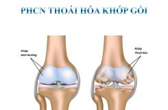 THOÁI HÓA KHỚP GỐI: NGUYÊN NHÂN, TRIỆU CHỨNG VÀ HƯỚNG ĐIỀU TRỊ HIỆU QUẢ BẰNG VẬT LÝ TRỊ LIỆU