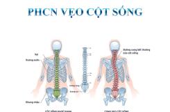 ĐIỀU TRỊ VẸO CỘT SỐNG Ở TRẺ EM: PHÁT HIỆN SỚM – CAN THIỆP ĐÚNG – GIẢM THIỂU BIẾN CHỨNG LÂU DÀI