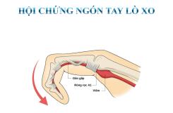 BỆNH LÝ NGÓN TAY LÒ XO: HIỂU ĐÚNG ĐỂ ĐIỀU TRỊ HIỆU QUẢ