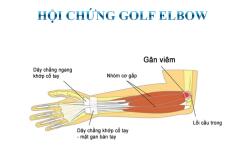 GOLF ELBOW – VIÊM LỒI CẦU TRONG: CƠN ĐAU ÂM Ỉ KHÔNG CHỈ CỦA NGƯỜI CHƠI GOLF