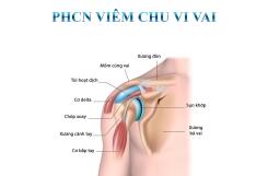 VIÊM CHU VI VAI – ĐỪNG ĐỂ CƠ VẬN ĐỘNG VAI BỊ “ĐÓNG BĂNG”