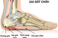 GAI GÓT CHÂN: ĐỪNG ĐỂ MỖI BƯỚC ĐI TRỞ THÀNH CỰC HÌNH – HÃY ĐIỀU TRỊ DỨT ĐIỂM CHỈ SAU 5-7 BUỔI TẠI VIỆN PHYSIO