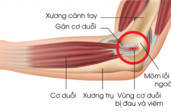 TENNIS ELBOW – VIÊM LỒI CẦU NGOÀI: ĐỪNG ĐỂ CƠN ĐAU ÂM Ỉ LÀM GIÁN ĐOẠN CUỘC SỐNG CỦA BẠN